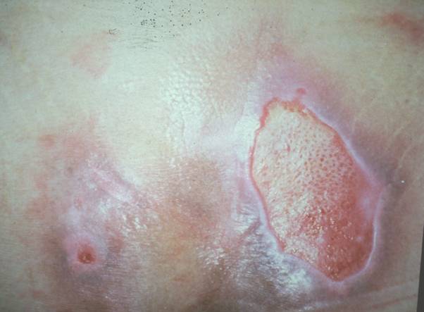 Listhesis stade 1 picture