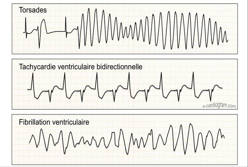 Tachycardies supra-ventriculaires et ventriculaires et facteurs ...