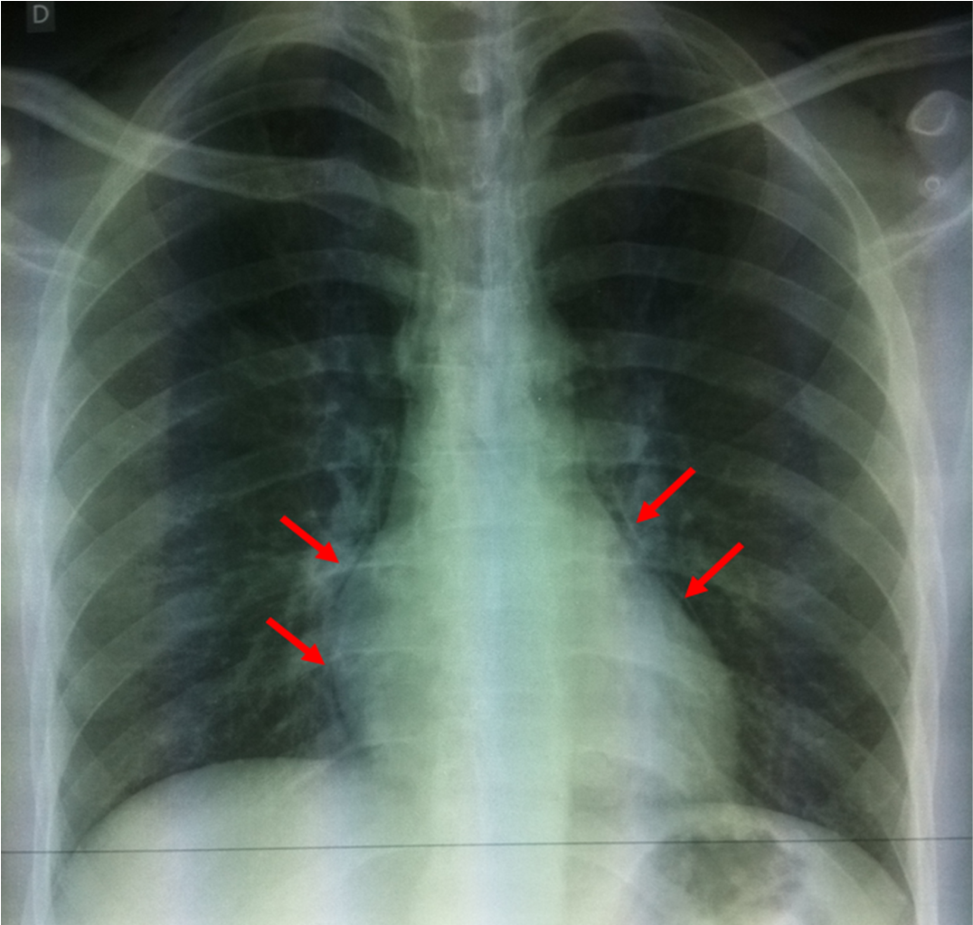 Pneumothorax spontané de l'adulte - Urgences-Online