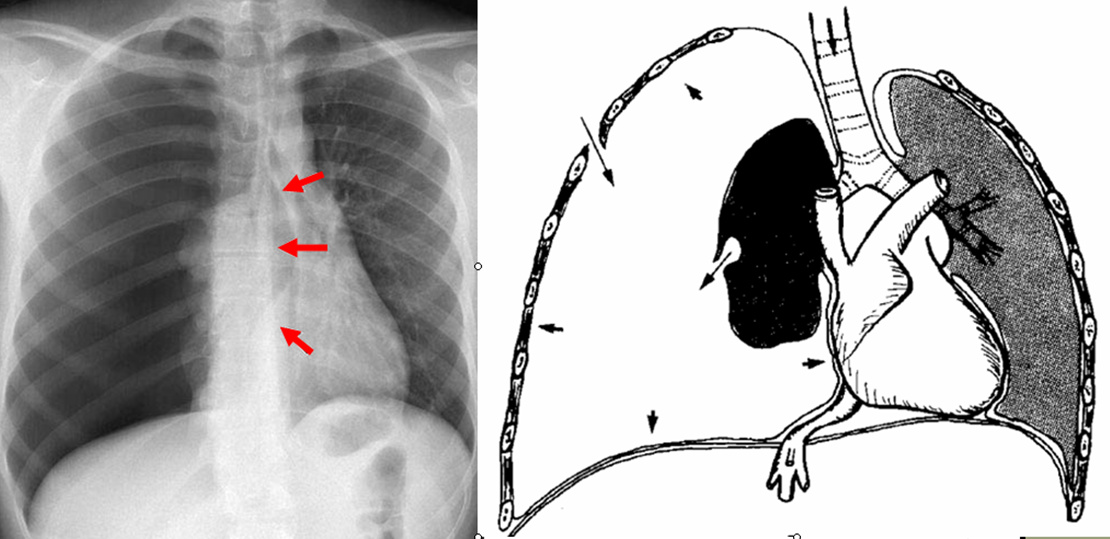 Pneumothorax spontané de l'adulte - Médecine d'urgence. 